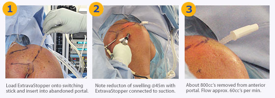 ClearVu Is the Only Cannula Engineered to Bend With an Articulating Joint