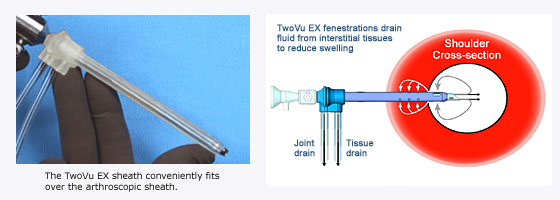 TwoVu EX Scope Sheath Also Boasts Anti-Extravasation Capabilities